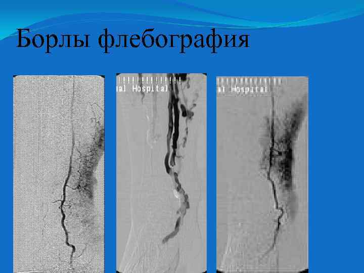 Борлы флебография 