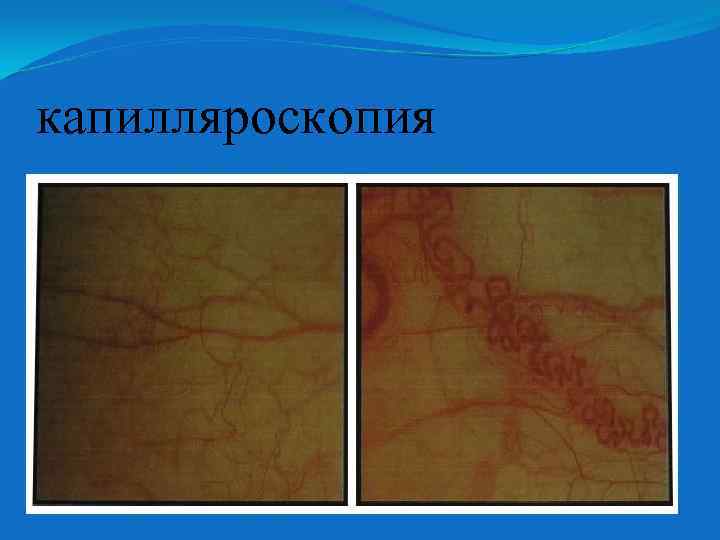 капилляроскопия 