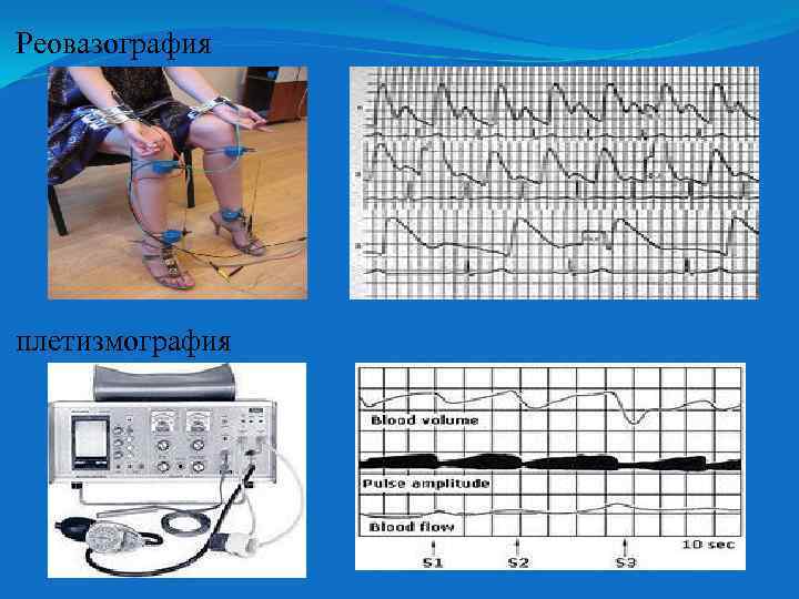 Реовазография плетизмография 