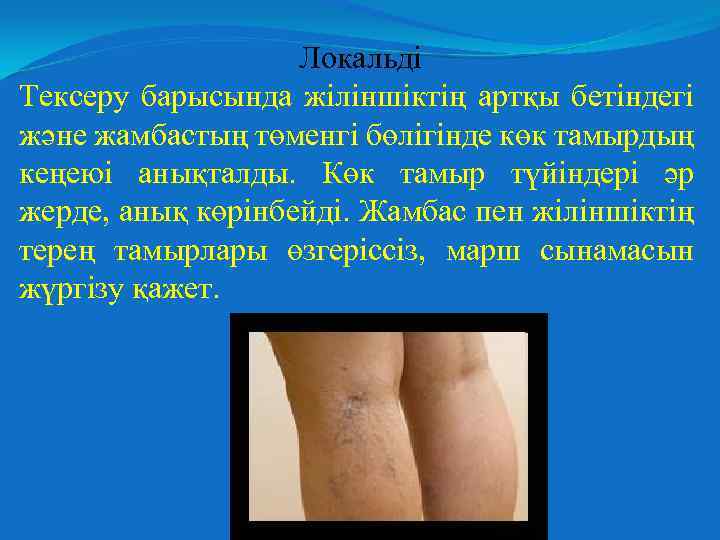 Локальді Тексеру барысында жіліншіктің артқы бетіндегі және жамбастың төменгі бөлігінде көк тамырдың кеңеюі анықталды.