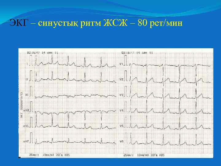 ЭКГ – синустық ритм ЖСЖ – 80 рет/мин 