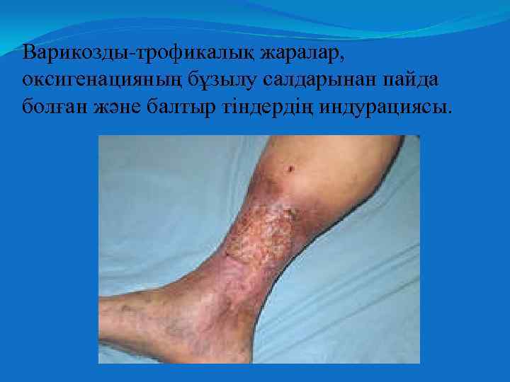 Варикозды-трофикалық жаралар, оксигенацияның бұзылу салдарынан пайда болған және балтыр тіндердің индурациясы. 