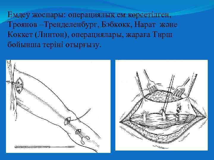 Емдеу жоспары операциялық ем көрсетілген, Троянов –Тренделенбург, Бэбкокк, Нарат және Коккет (Линтон), операциялары, жараға