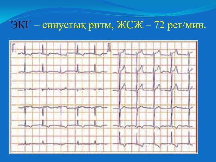 ЭКГ – синустық ритм, ЖСЖ – 72 рет/мин. 