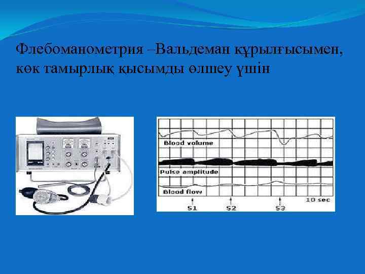 Флебоманометрия –Вальдеман құрылғысымен, көк тамырлық қысымды өлшеу үшін 