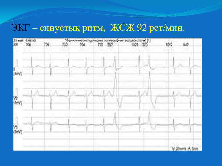 ЭКГ – синустық ритм, ЖСЖ 92 рет/мин. 