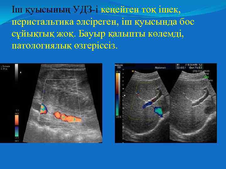 Іш қуысының УДЗ-і кеңейген тоқ ішек, перистальтика әлсіреген, іш қуысында бос сұйықтық жоқ. Бауыр