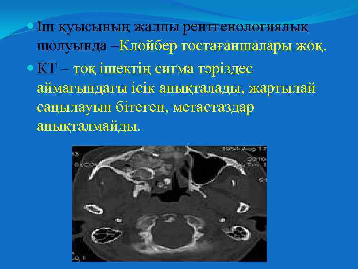  Іш қуысының жалпы рентгенологиялық шолуында –Клойбер тостағаншалары жоқ. КТ – тоқ ішектің сигма