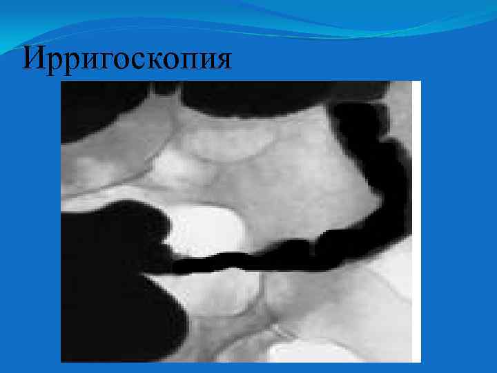 Ирригоскопия 
