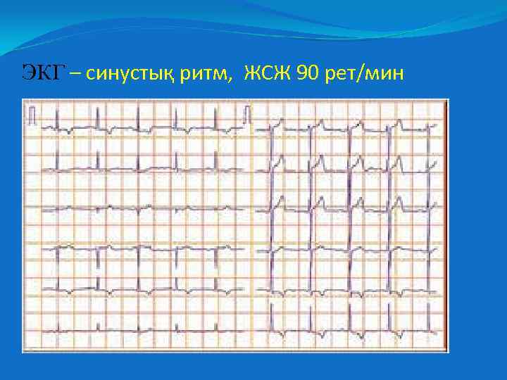 ЭКГ – синустық ритм, ЖСЖ 90 рет/мин 