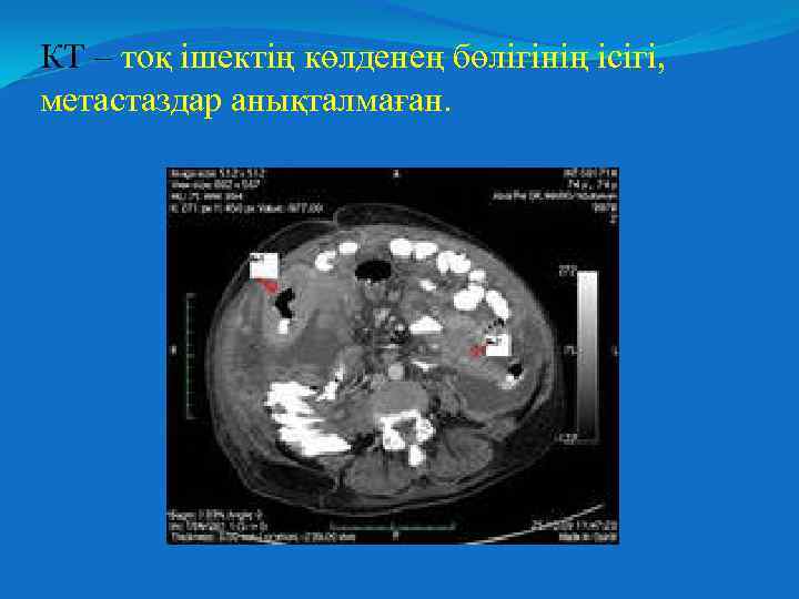 КТ – тоқ ішектің көлденең бөлігінің ісігі, метастаздар анықталмаған. 
