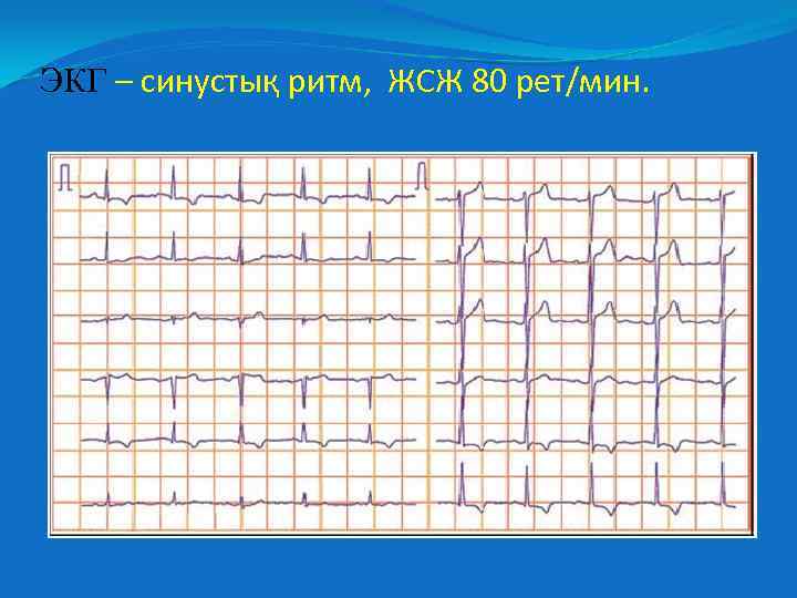ЭКГ – синустық ритм, ЖСЖ 80 рет/мин. 