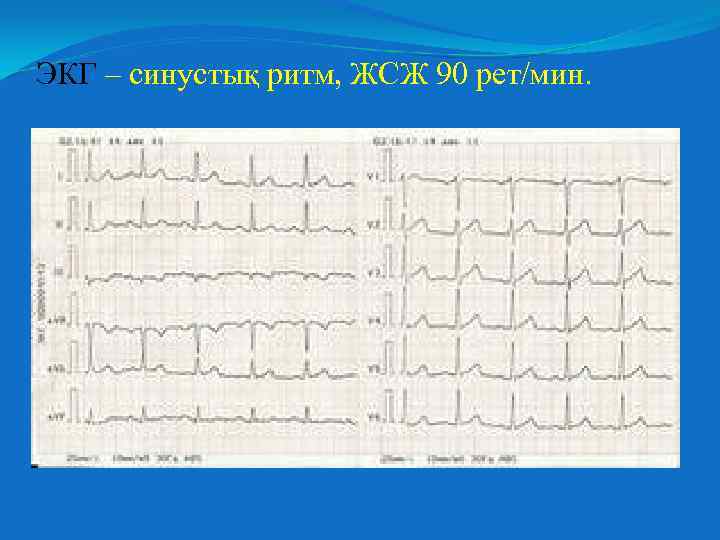 ЭКГ – синустық ритм, ЖСЖ 90 рет/мин. 
