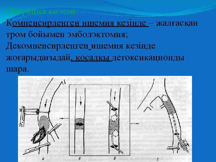 Операция көлемі: Компенсирленген ишемия кезінде – жалғасқан тром бойымен эмболэктомия; Декомпенсирленген ишемия кезінде жоғарыдағыдай,