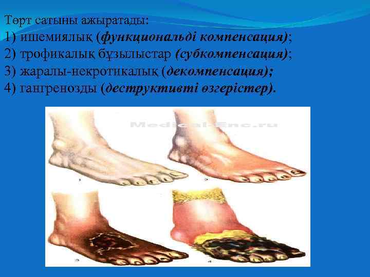 Төрт сатыны ажыратады: 1) ишемиялық (функциональді компенсация); 2) трофикалық бұзылыстар (субкомпенсация); 3) жаралы-некротикалық (декомпенсация);