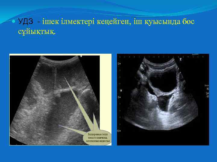  УДЗ - ішек ілмектері кеңейген, іш қуысында бос сұйықтық. 