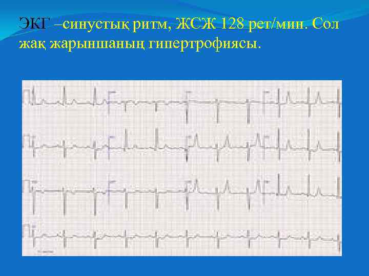 ЭКГ –синустық ритм, ЖСЖ 128 рет/мин. Сол жақ жарыншаның гипертрофиясы. 