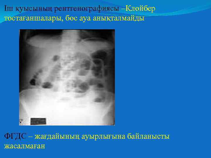 Іш қуысының рентгенографиясы –Клойбер тостағаншалары, бос ауа анықталмайды ФГДС – жағдайының ауырлығына байланысты жасалмаған