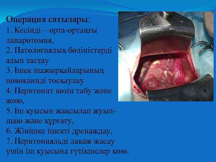 Операция сатылары: 1. Кесінді – орта-ортаңғы лапаротомия, 2. Патологиялық бөліністерді алып тастау 3. Ішек