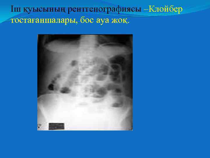 Іш қуысының рентгенографиясы –Клойбер тостағаншалары, бос ауа жоқ. 