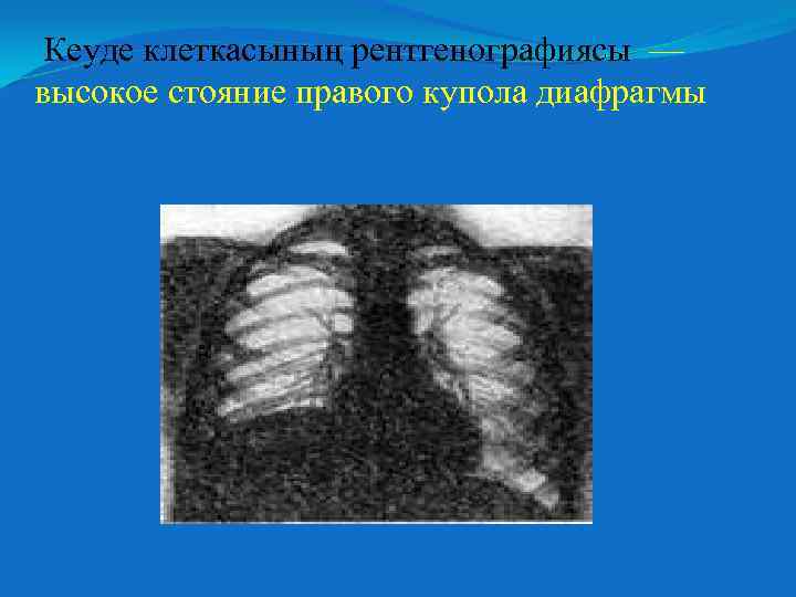 Кеуде клеткасының рентгенографиясы –– высокое стояние правого купола диафрагмы 