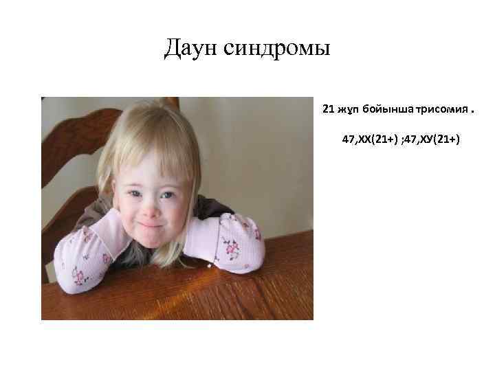 Даун синдромы 21 жұп бойынша трисомия. 47, ХХ(21+) ; 47, ХУ(21+) 