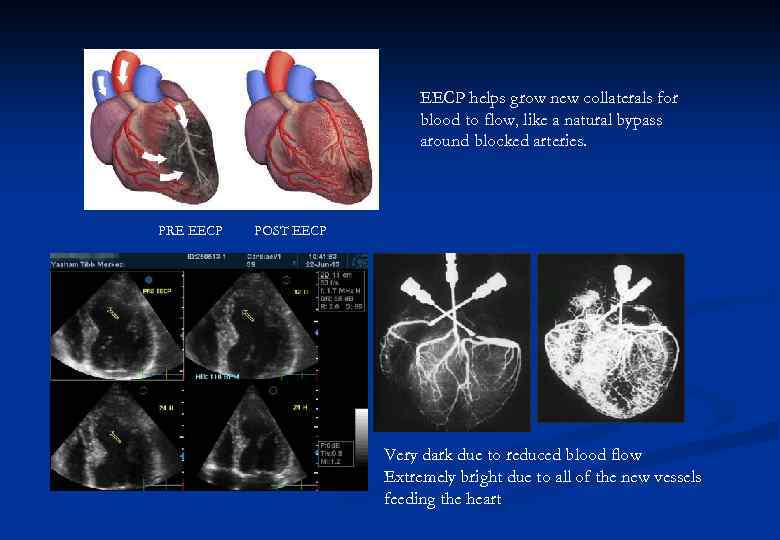 EECP helps grow new collaterals for blood to flow, like a natural bypass around