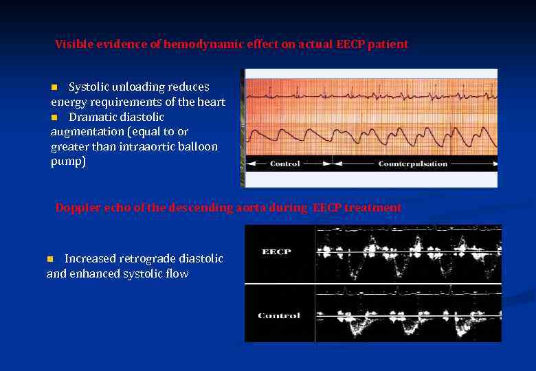 Visible evidence of hemodynamic effect on actual EECP patient Systolic unloading reduces energy requirements