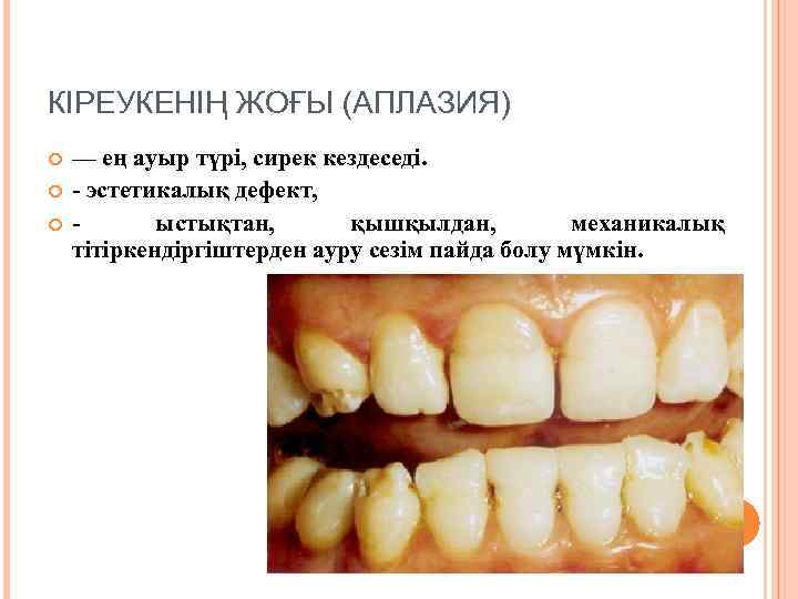 КІРЕУКЕНІҢ ЖОҒЫ (АПЛАЗИЯ) — ең ауыр түрі, сирек кездеседі. - эстетикалық дефект, ыстықтан, қышқылдан,