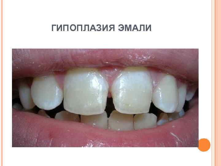 ГИПОПЛАЗИЯ ЭМАЛИ 