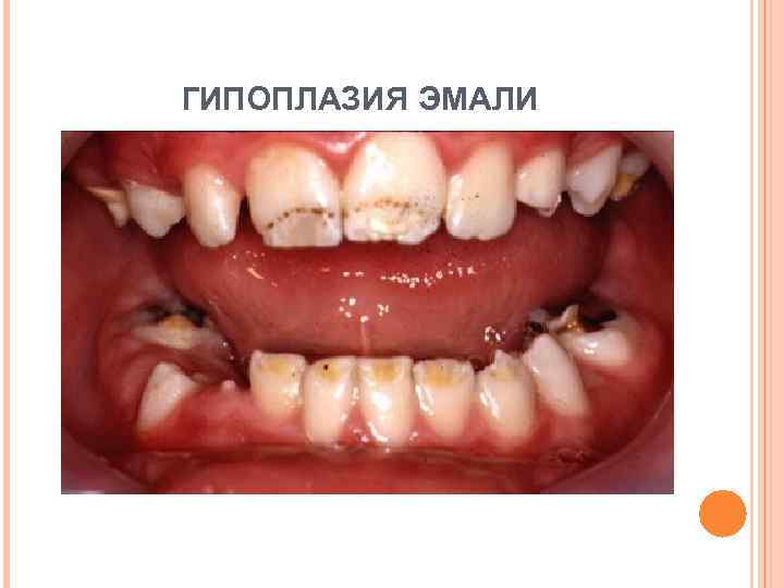ГИПОПЛАЗИЯ ЭМАЛИ 