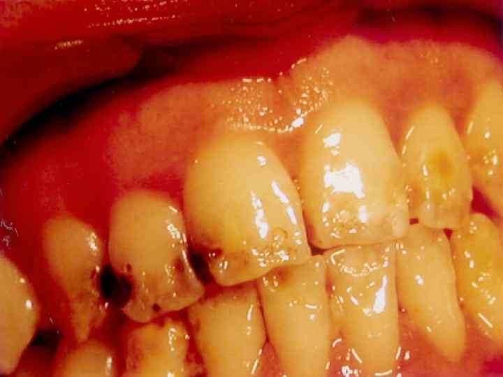 ГИПОПЛАЗИЯ ЭМАЛИ 