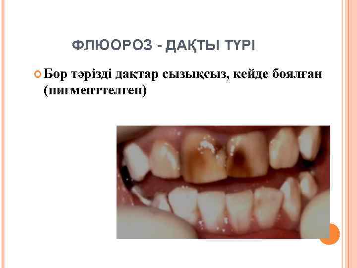 ФЛЮОРОЗ - ДАҚТЫ ТҮРІ Бор тәрізді дақтар сызықсыз, кейде боялған (пигменттелген) 