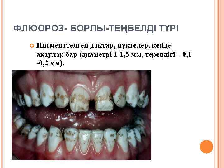 ФЛЮОРОЗ- БОРЛЫ-ТЕҢБЕЛДІ ТҮРІ Пигменттелген дақтар, нүктелер, кейде ақаулар бар (диаметрі 1 -1, 5 мм,