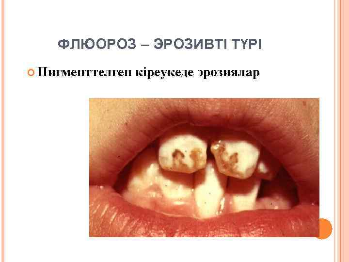 ФЛЮОРОЗ – ЭРОЗИВТІ ТҮРІ Пигменттелген кіреукеде эрозиялар 