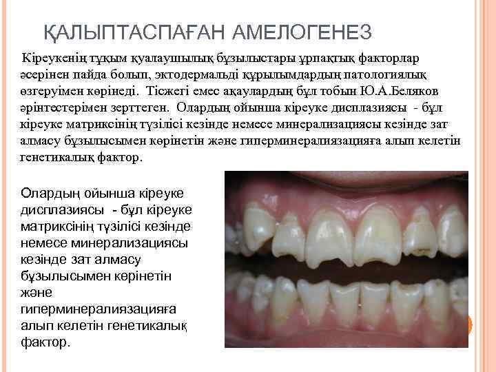 ҚАЛЫПТАСПАҒАН АМЕЛОГЕНЕЗ Кіреукенің тұқым қуалаушылық бұзылыстары ұрпақтық факторлар әсерінен пайда болып, эктодермальді құрылымдардың патологиялық