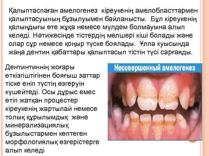 Қалыптаспаған амелогенез кіреукенің амелобласттармен қалыптасуының бұзылуымен байланысты. Бұл кіреукенің қалыңдығы өте жұқа немесе мүлдем