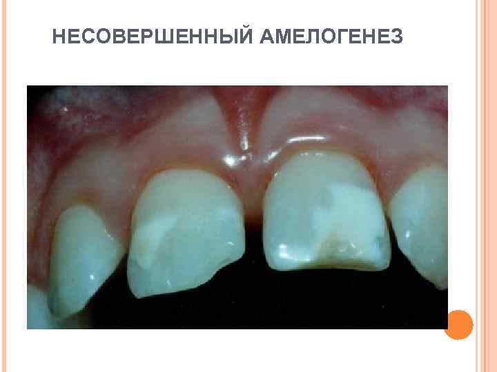 НЕСОВЕРШЕННЫЙ АМЕЛОГЕНЕЗ 