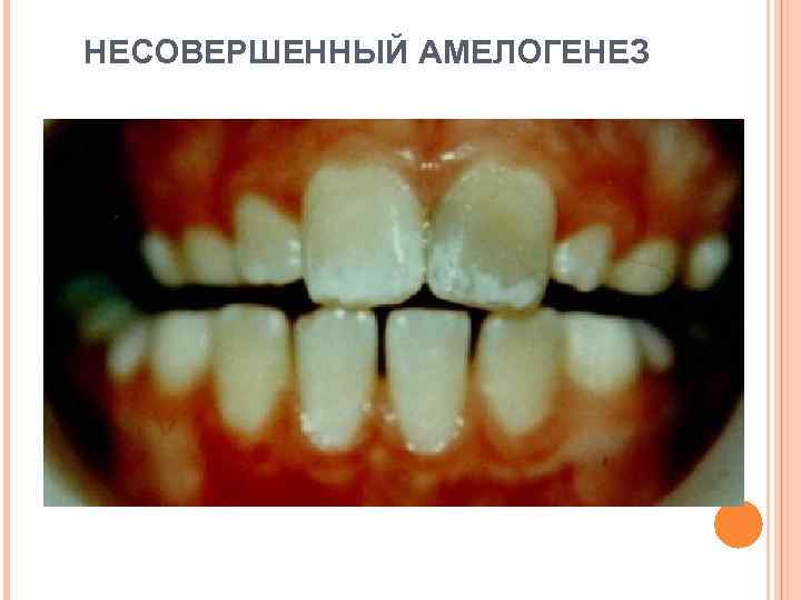 НЕСОВЕРШЕННЫЙ АМЕЛОГЕНЕЗ 