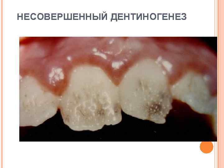 НЕСОВЕРШЕННЫЙ ДЕНТИНОГЕНЕЗ 