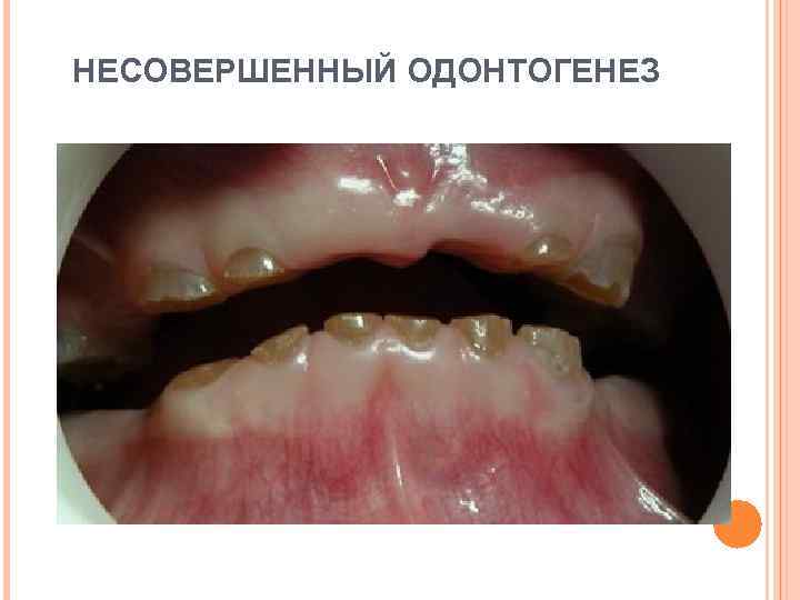 НЕСОВЕРШЕННЫЙ ОДОНТОГЕНЕЗ 