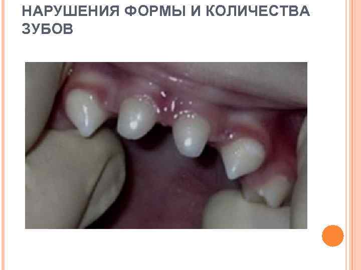 НАРУШЕНИЯ ФОРМЫ И КОЛИЧЕСТВА ЗУБОВ 