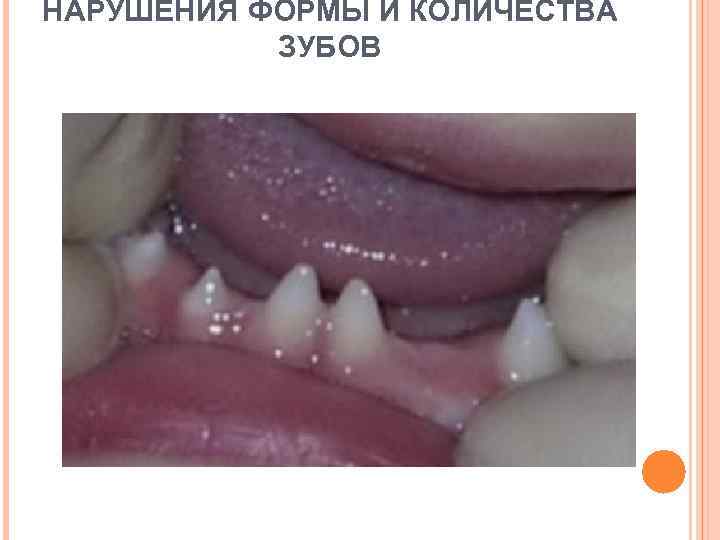 НАРУШЕНИЯ ФОРМЫ И КОЛИЧЕСТВА ЗУБОВ 