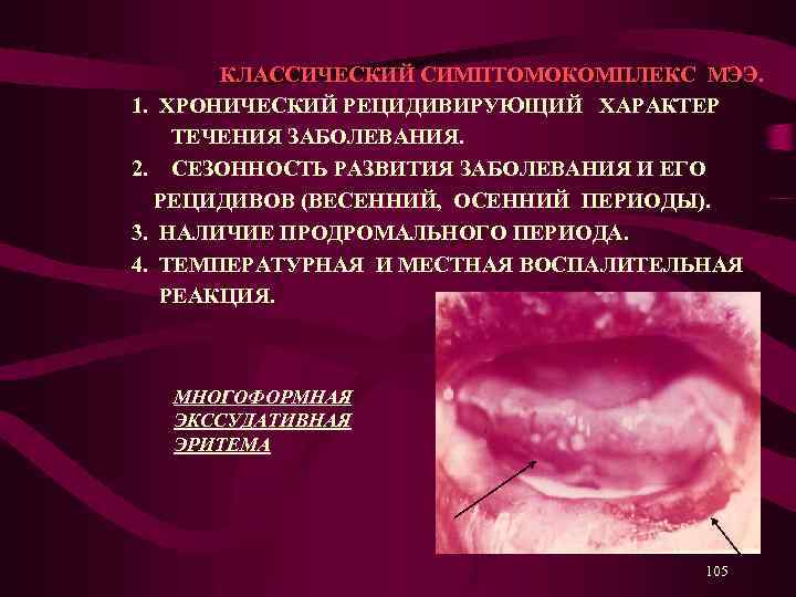  КЛАССИЧЕСКИЙ СИМПТОМОКОМПЛЕКС МЭЭ. 1. ХРОНИЧЕСКИЙ РЕЦИДИВИРУЮЩИЙ ХАРАКТЕР ТЕЧЕНИЯ ЗАБОЛЕВАНИЯ. 2. СЕЗОННОСТЬ РАЗВИТИЯ ЗАБОЛЕВАНИЯ