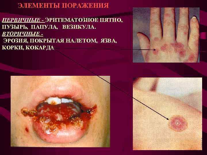 ЭЛЕМЕНТЫ ПОРАЖЕНИЯ ПЕРВИЧНЫЕ - ЭРИТЕМАТОЗНОЕ ПЯТНО, ПУЗЫРЬ, ПАПУЛА, ВЕЗИКУЛА. ВТОРИЧНЫЕ ЭРОЗИЯ, ПОКРЫТАЯ НАЛЕТОМ, ЯЗВА,