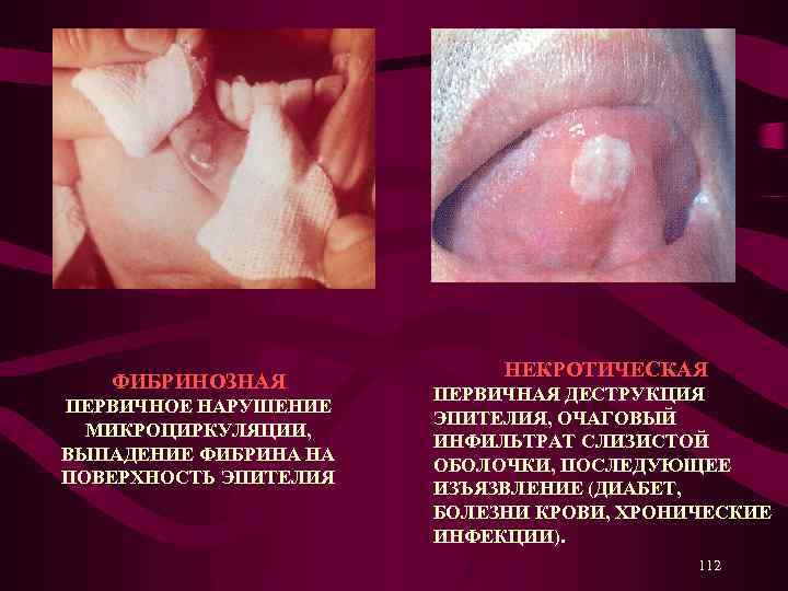 ФИБРИНОЗНАЯ ПЕРВИЧНОЕ НАРУШЕНИЕ МИКРОЦИРКУЛЯЦИИ, ВЫПАДЕНИЕ ФИБРИНА НА ПОВЕРХНОСТЬ ЭПИТЕЛИЯ НЕКРОТИЧЕСКАЯ ПЕРВИЧНАЯ ДЕСТРУКЦИЯ ЭПИТЕЛИЯ, ОЧАГОВЫЙ