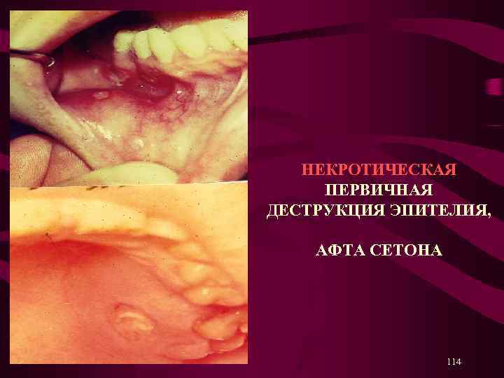 НЕКРОТИЧЕСКАЯ ПЕРВИЧНАЯ ДЕСТРУКЦИЯ ЭПИТЕЛИЯ, АФТА СЕТОНА 114 