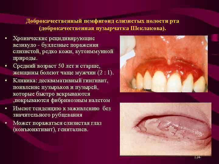 Рак слизистой полости рта фото симптомы