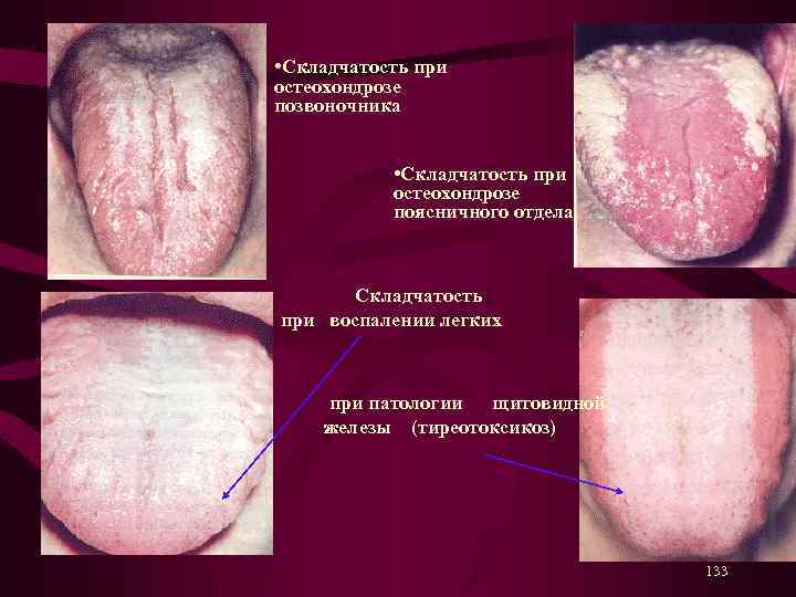  • Складчатость при остеохондрозе позвоночника • Складчатость при остеохондрозе поясничного отдела Складчатость при