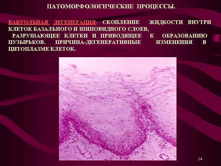  ПАТОМОРФОЛОГИЧЕСКИЕ ПРОЦЕССЫ. ВАКУОЛЬНАЯ ДЕГЕНЕРАЦИЯ- СКОПЛЕНИЕ ЖИДКОСТИ ВНУТРИ КЛЕТОК БАЗАЛЬНОГО И ШИПОВИДНОГО СЛОЕВ, РАЗРУШАЮЩЕЕ